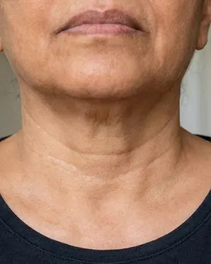 Neck folds