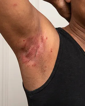 Underarms