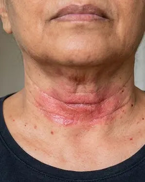 Neck folds
